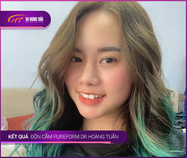 Kết quả độn cằm Pureform Thẩm mỹ Hoàng Tuấn